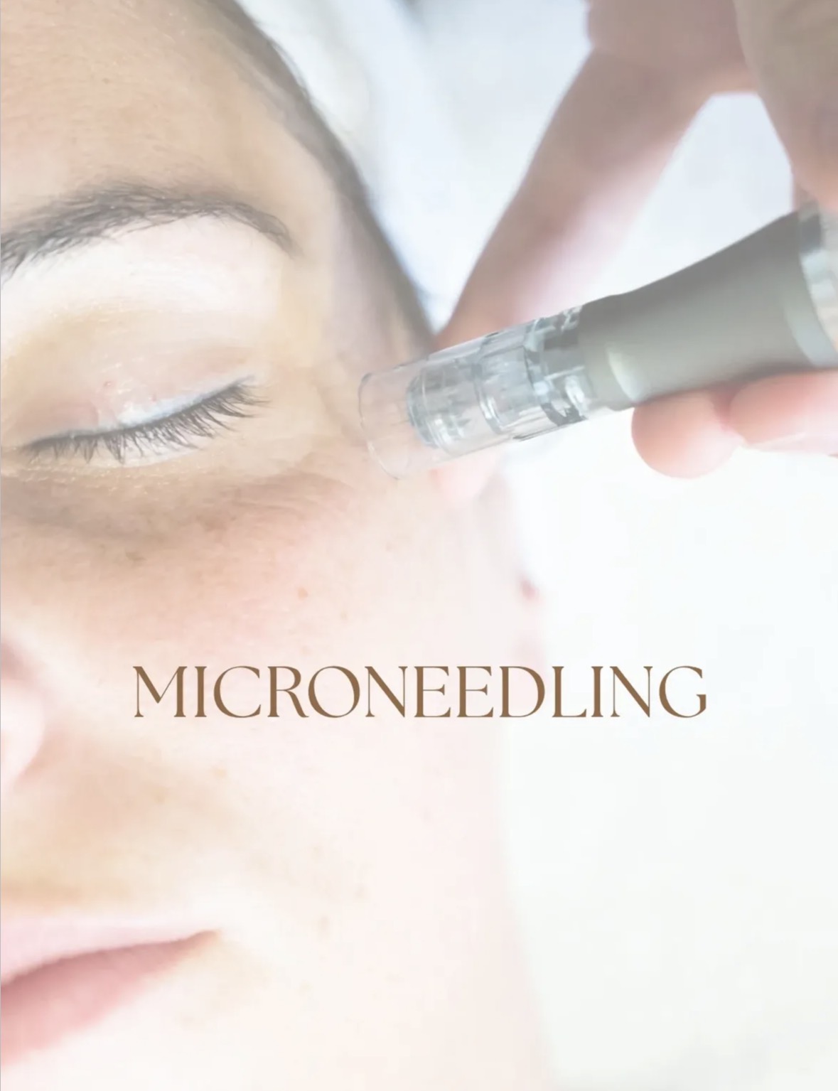 Instagrampost: microneedling-behandeling van dichtbij