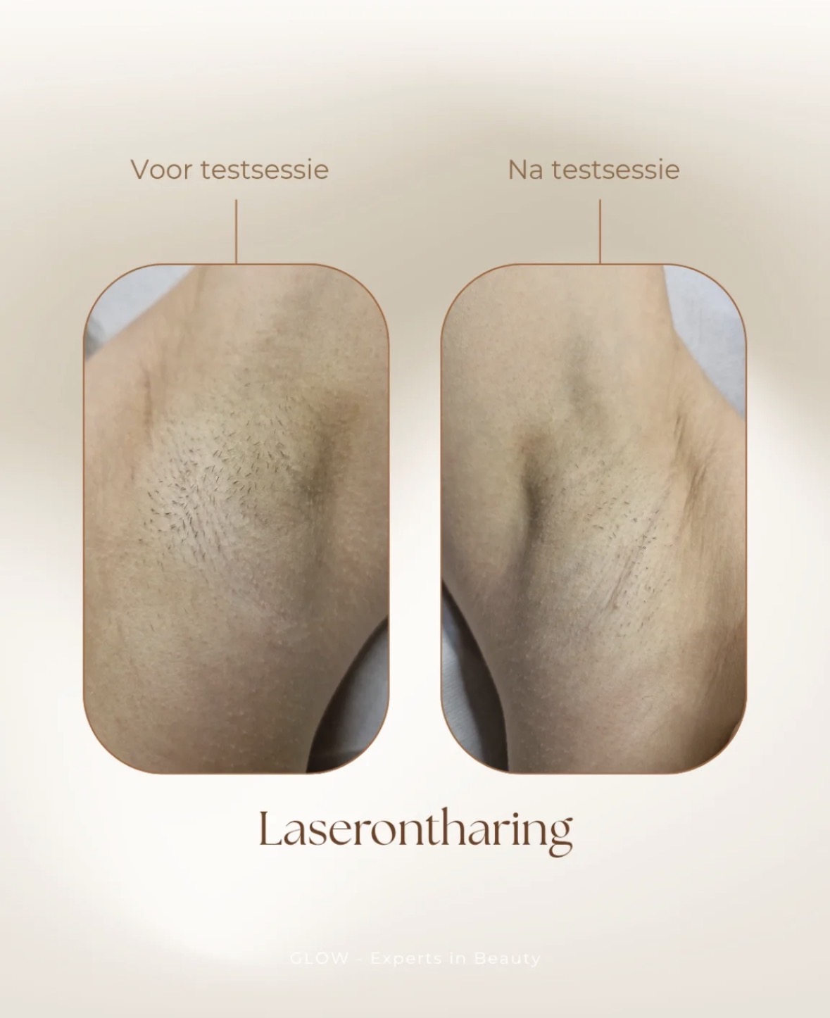 Instagrampost: laserontharing voor en na één testsessie